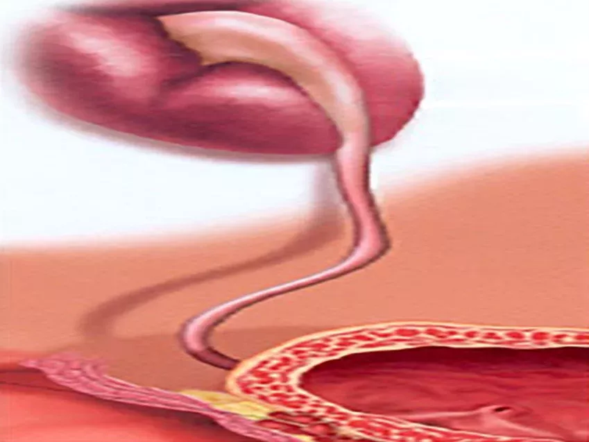 Información sobre tumor de uréter en el ámbito de la urología oncológica.