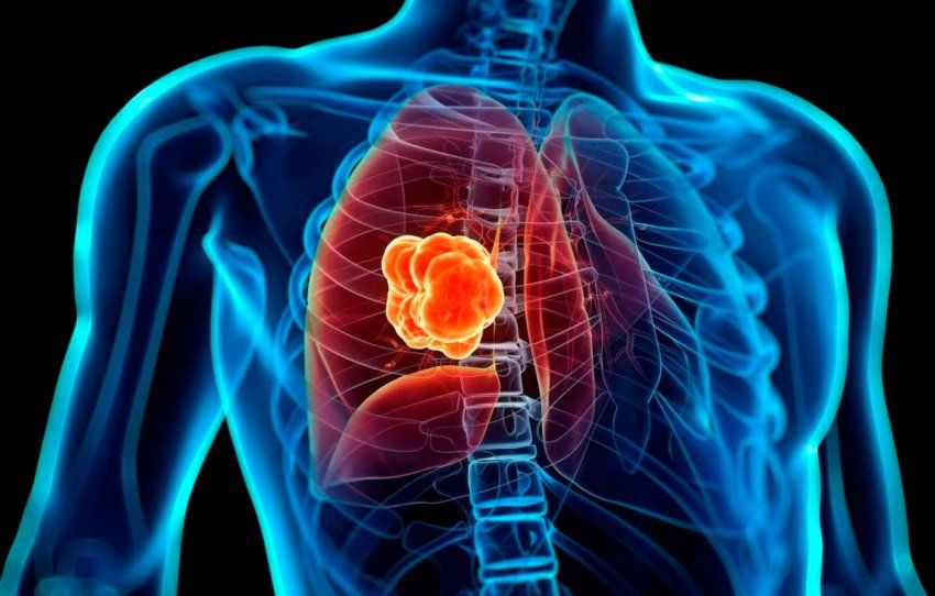 Cirugía de las metástasis en urología Cirugía de las metástasis en urología