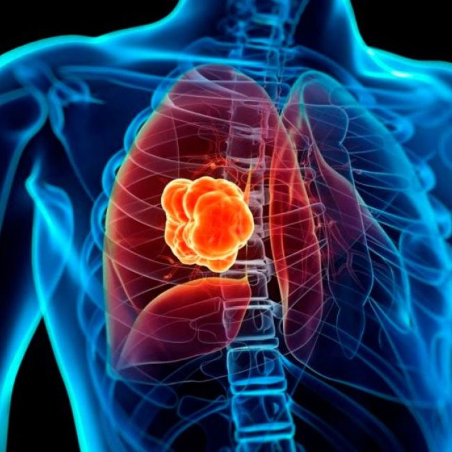 Cirugía de las metástasis en urología