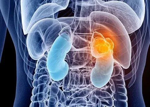 Información sobre crioterapia aplicada al cáncer de riñón en el ámbito urológico.
