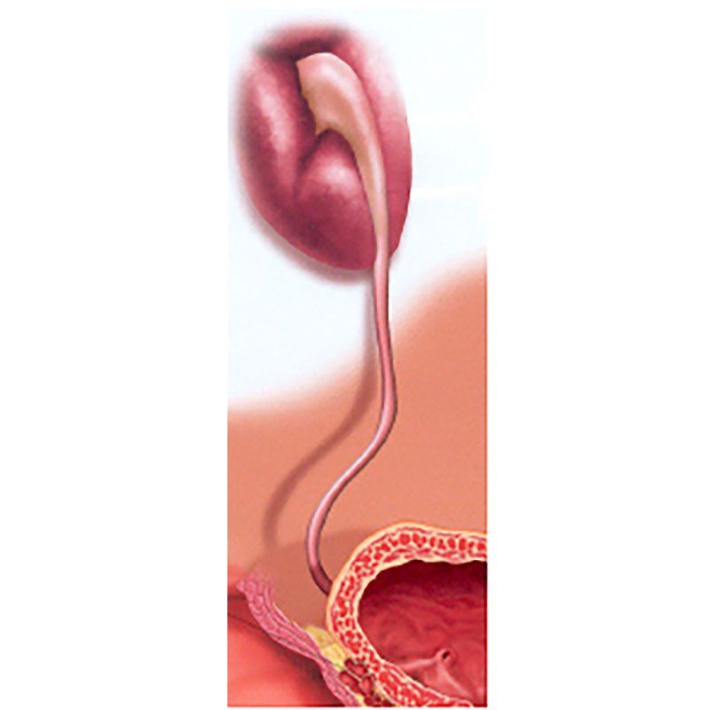 Tumor de uréter Tumor de uréter