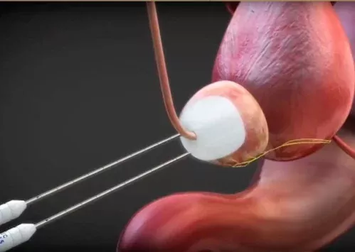 Información sobre crioterapia como tratamiento del cáncer de próstata.
