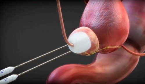La crioterapia en el cáncer de próstata