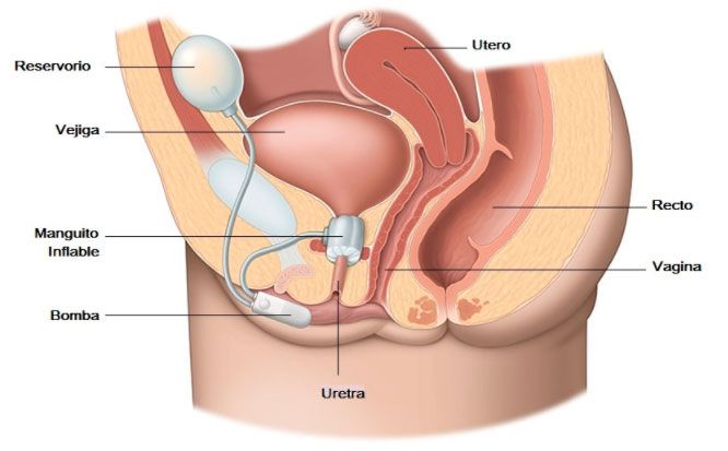 Un dispositivo para la compresión de la uretra trata la