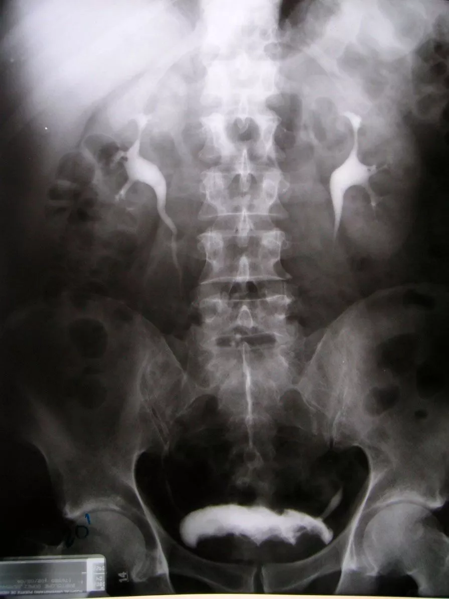 Urografía intravenosa en diagnóstico urológico Información sobre urografía intravenosa en el ámbito del diagnóstico urológico