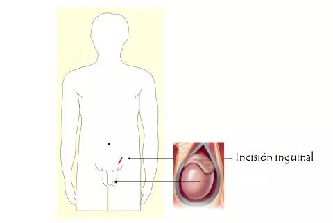 Información sobre orquiectomía radical en el ámbito de la urología oncológica