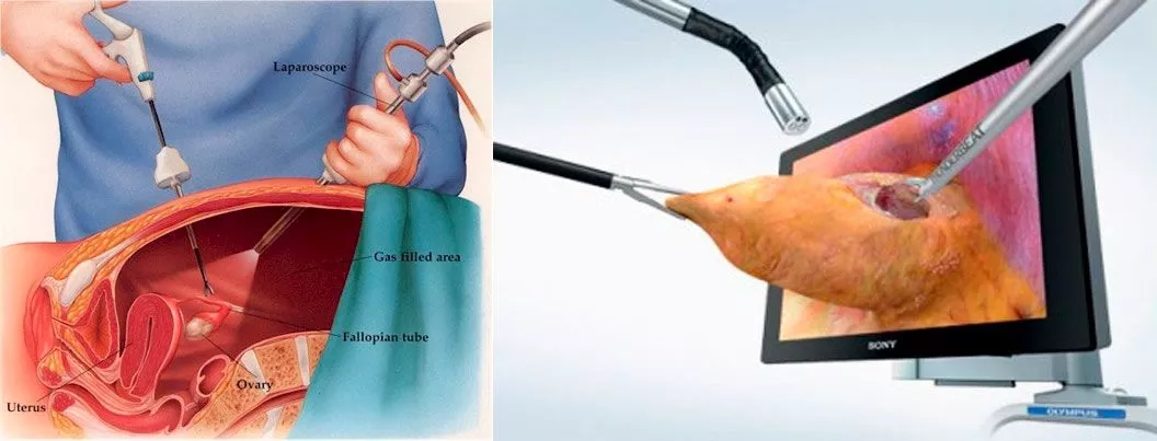 Cirugía laparoscópica 3D en UMI Información sobre cirugía laparoscópica 3D en tratamientos urológicos de mínima invasión