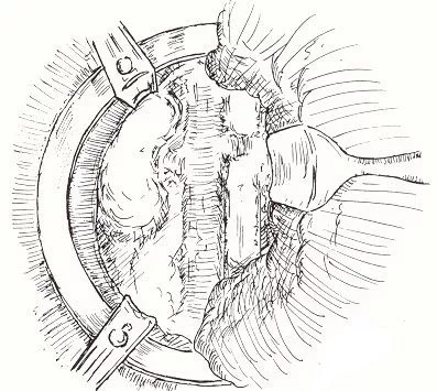 Nefrectomía radical abierta en uro-oncología Información sobre nefrectomía radical abierta en el ámbito de la urología oncológica