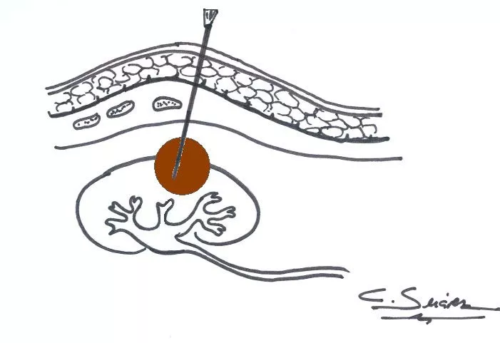 BAG y biopsia en diagnóstico urológico Información sobre BAG o biopsia como prueba diagnóstica en urología
