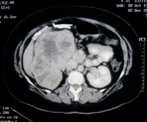 TAC en uro-oncología Información sobre TAC en el estudio de patologías urológicas y oncológicas