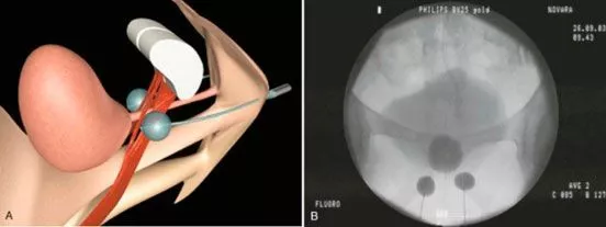 Balones implantables para compresión uretral Información sobre balones implantables en técnicas de compresión uretral