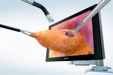 Laparoscopia 3D en cirugía renal Información sobre laparoscopia 3D en cirugía renal dentro del ámbito urológico