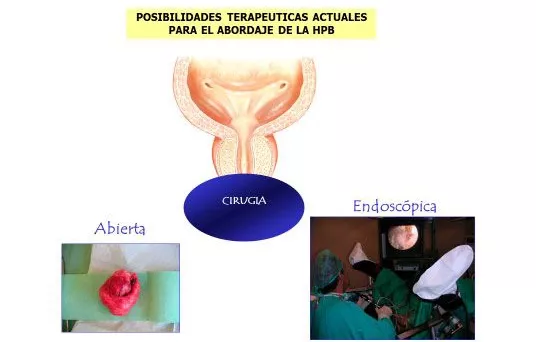 Tratamiento transuretral de la HPB en UMI Información sobre técnicas transuretrales para tratar la hiperplasia prostática benigna