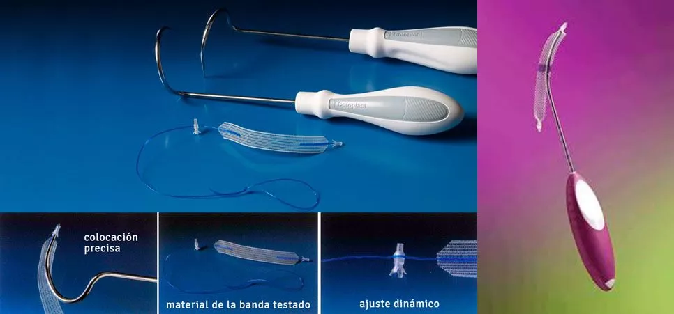 Minisling para soporte uretral Información sobre minisling en técnicas de soporte uretral para la incontinencia urinaria