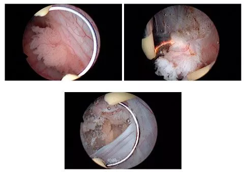 Tumores vesicales superficiales en uro-oncología Información sobre tumores vesicales superficiales en el ámbito de la urología oncológica