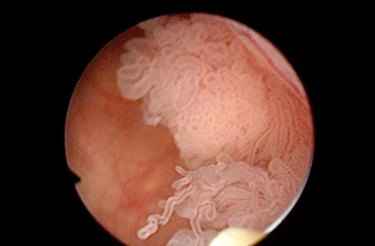 Cistoscopia en diagnóstico urológico Información sobre cistoscopia dentro de las pruebas diagnósticas urológicas