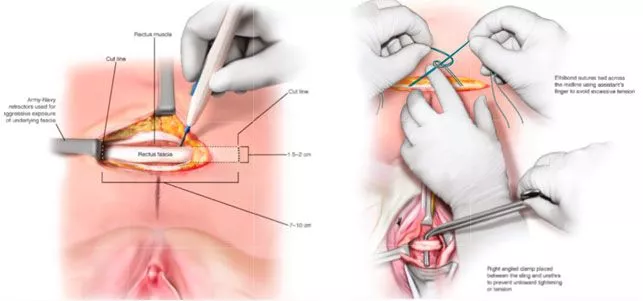 Sling suburetral autólogo para incontinencia urinaria Información sobre la técnica de cabestrillo suburetral autólogo en urología