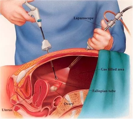 Cirugía laparoscópica 3D renal Información sobre cirugía laparoscópica 3D aplicada a tratamientos renales urológicos.