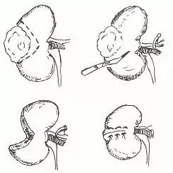Cirugía conservadora renal en uro-oncología Información sobre cirugía conservadora renal en el ámbito de la urología oncológica